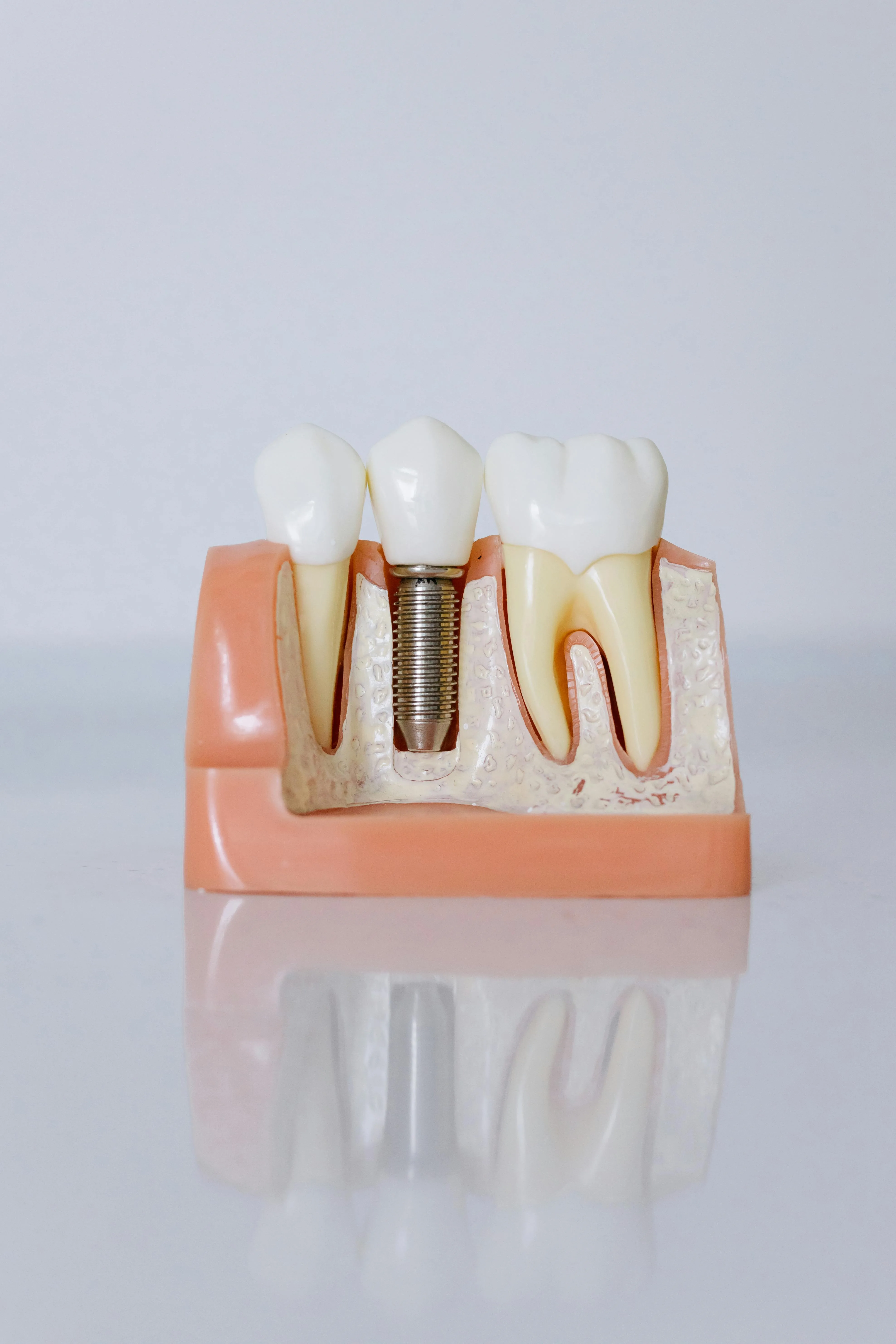 Missing Tooth Solutions